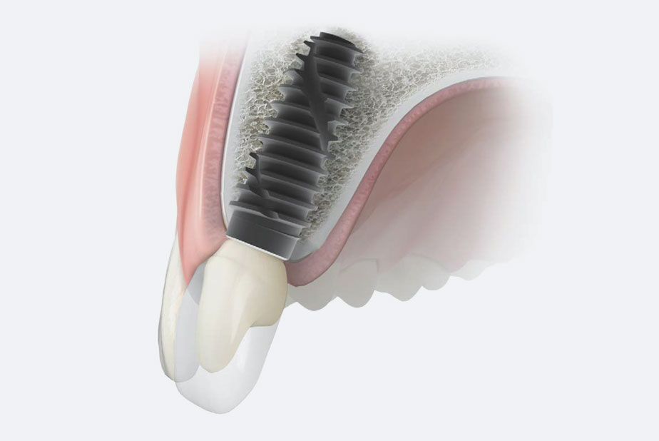 Linea implantare IS+