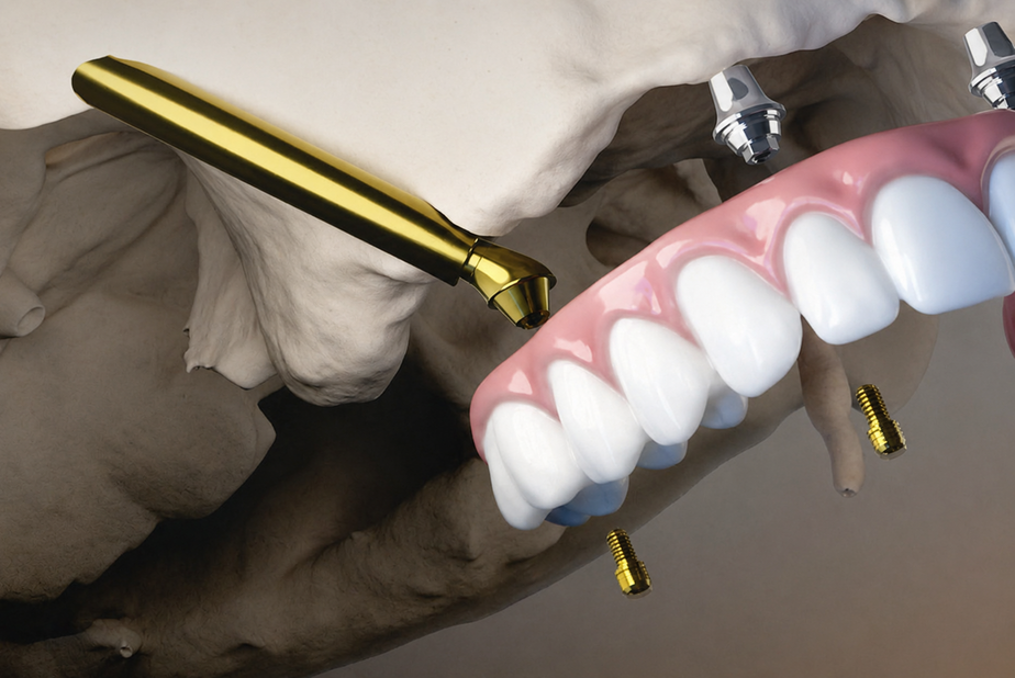 BioHorizons lancia ProZygoma ProZygoma di BioHorizons