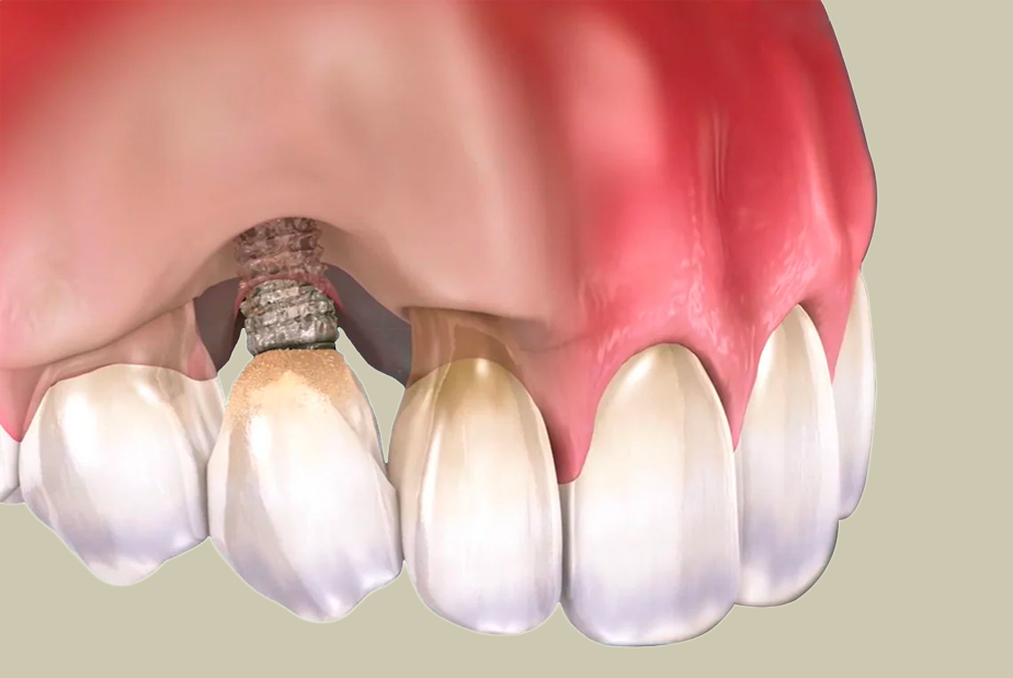 Peri-implantite