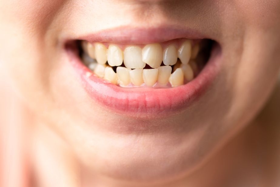 affollamento dentale