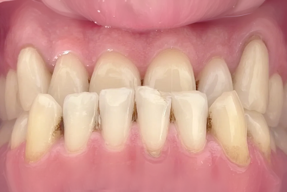 Morso inverso associato a un maggior rischio di perdita dentale Morso inverso