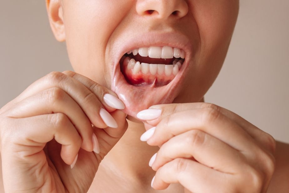 Postbiotici e infiammazione gengivale: cosa emerge dal nuovo studio clinico Primo piano di bocca