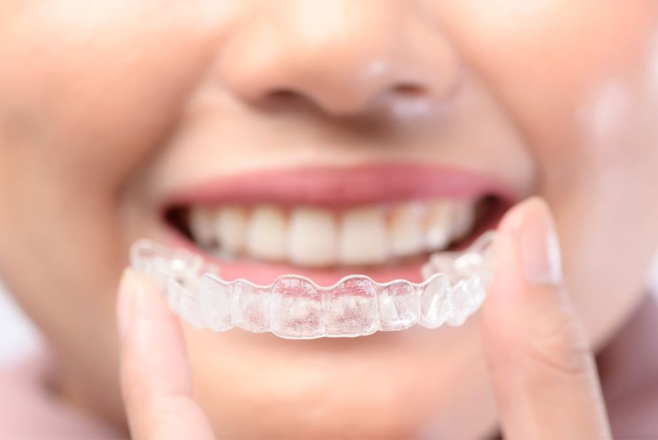 Terapia con aligner: le linee guida condivise da SIDO Aligner trasparenti