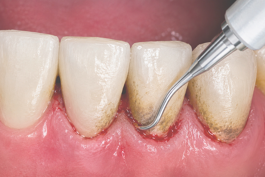 debridement sottogengivale