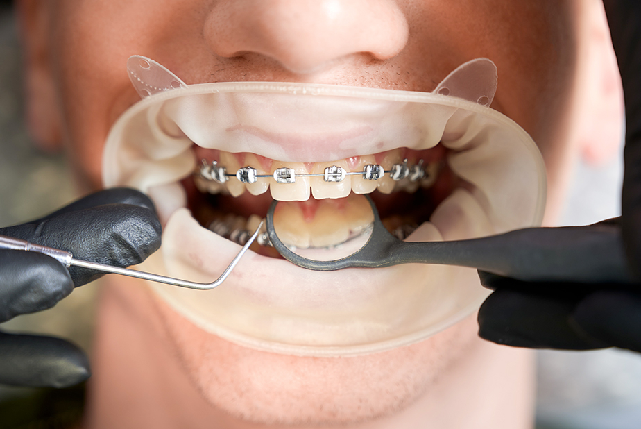Ipofosfatasia lieve e forze ortodontiche primo piano di dentatura con apparecchio fisso
