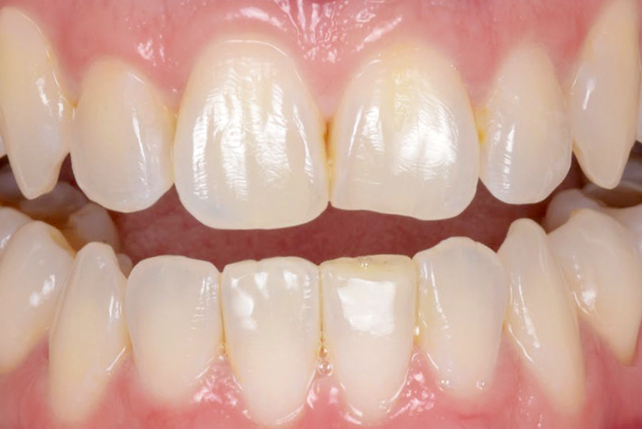 Miglioramento estetico trattamento post-ortodontico con 3M™ Filtek™ Easy Match Universal Restorative Risultato finale dopo miglioramento estetico