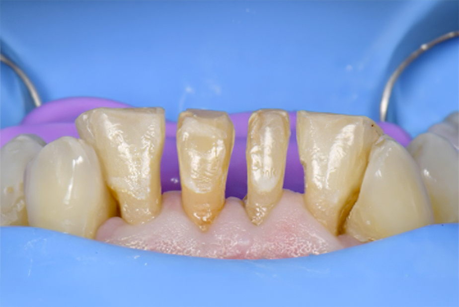 Tecnica Injection Molding per faccette dirette con Solventum™ Filtek™ Easy Match Flowable Restorative Tecnica Injection Molding per faccette dirette