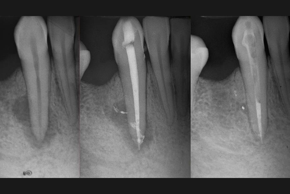 Endodonzia clinica: un percorso pratico dalla diagnosi alla gestione del caso trattamento endodontico
